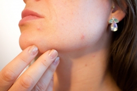 Your Guide To Acne Scar Removal In Singapore
