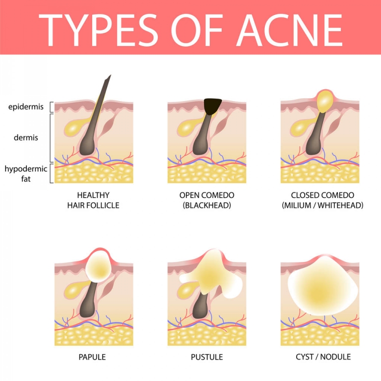 Your Guide To Acne Scar Removal In Singapore your-guide-to-acne-scar-removal-in-singapore