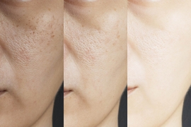 Melasma: Causes, Prevention & Treatment Options In Singapore